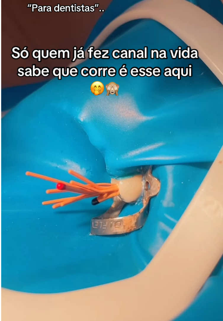 Uma das maiores dificuldades do dentista antes de fechar o canal é a prova do cone e sem dúvidas a colocação dos cones no conduto, principalmete quando o dente é extremamente amplo e requer além do cone principal, vários cones acessórios… São dificuldades assim que eu gosto de enfrentar.. Afinal, dificuldades preparam pessoas comuns para destinos extraordinários !! ✨ #foryou #fy #for #odontologia #canalbom #dentista #foryoupage❤️❤️ #canalsemdor #garotasapoiamgarotas💝🎀✨️ 