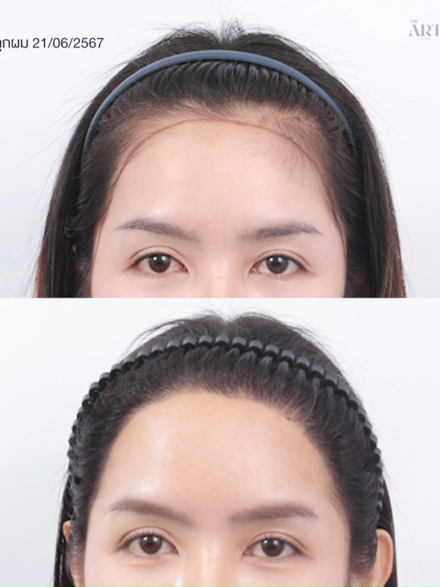ปัญหากรอบหน้าไม่ชัด ไรผมไม่สวย 👀 อย่างคุณแจส เลือกแก้ด้วย 