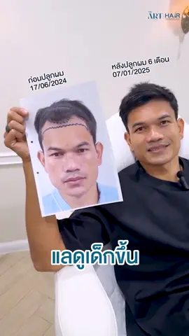 อัปเดต 6 เดือน ✨ เทียบให้ดูชัดๆ ไปเลยว่าเปลี่ยนไปยังไง ⚽ กับคุณกอล์ฟ อดิศักดิ์ ไกรษร #AK9 เคสนี้คุณหมอประเมิน 3000 กราฟ ปิดเว้าเอ็มอยู่หมัด 👍 . 💬สามารถสอบถามข้อมูลเพิ่มเติม หรือจองคิวและปรึกษา (เฉพาะปลูกผม) ได้ที่ 👇 Line OA : @thearthair Tel : 02 096 4505 . #ศัลยกรรม #รีวิวศัลยกรรม #ปลูกผมดิอาท #ปลูกผม #TheArtClinic #ปลูกผมถาวร #ผมร่วง #หัวล้าน #รีวิวปลูกผม #hairtransplan