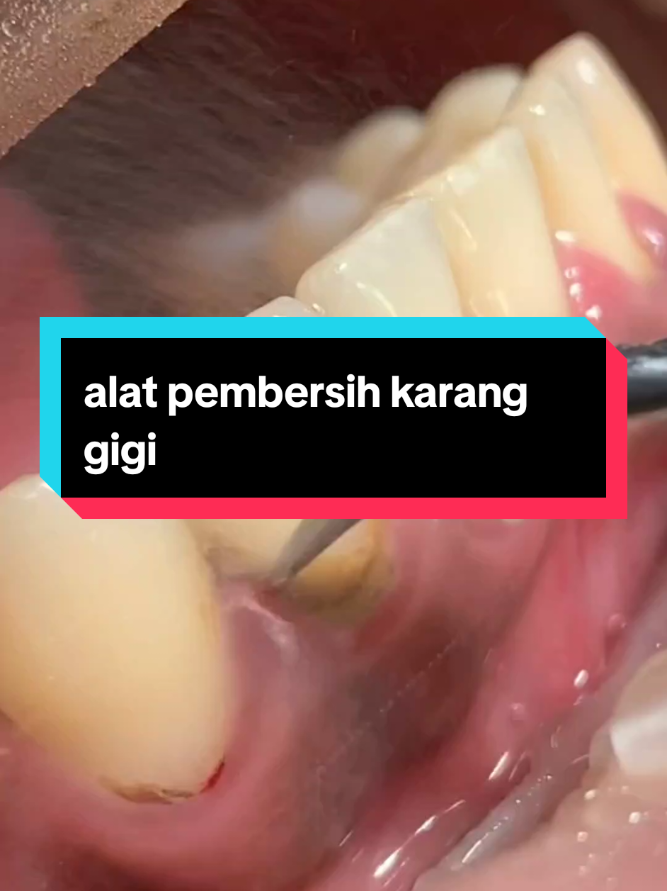pembersih karang gigi mandiri#airuidu#pembersihkaranggigi#airuidupembersihkaranggigi#airuidu#gigibersih#mulutsehat 