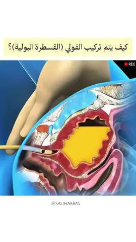كيف تُركّب قسطرة فولي؟ شرح سريع بخطوات دقيقة! تركيب القسطرة البولية (Foley Catheter) خطوة بخطوة خلال ثوانٍ! شاهد الطريقة الصحيحة للتعقيم، الإدخال، وتثبيت القسطرة مع شرح مبسّط ومعلومة طبية موثوقة. اشترك الآن لمزيد من المهارات التمريضية والشرح العملي مع صالح العباس. #تمريض #قسطرة_بولية #مهارات_تمريضية #صالح_العباس