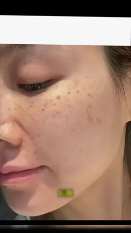 Da sạch nám – Mịn màng trắng hồng nhờ Collagen Hàn Quốc . Chống lão hóa – Mờ thâm nám – Da căng bóng như gái Hàn! #kemxoanam #datrangmin #collagenhanquoc #lamdepchuanhan