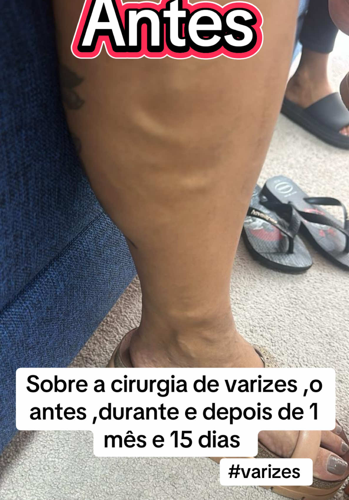 Explicando um pouco sobre a cor de varizes que eu fiz na perna . #cirugia #varizes #