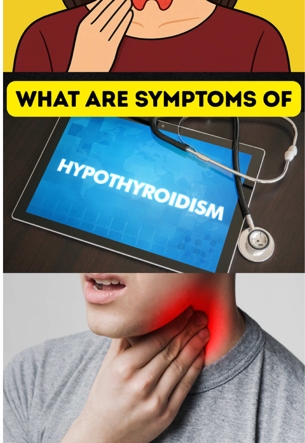 Hypothyroidism and weight gain. hypothyroidism symptoms can be weight gain, tiredness, constipation,dry skin, brittle hairs and nails, irregular periods,   Depression and many others. #hypothyroidism #weightgain #healthtips 