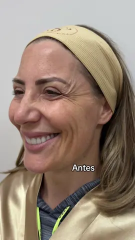 #rugas #envelhecimento #fy #mulheres 