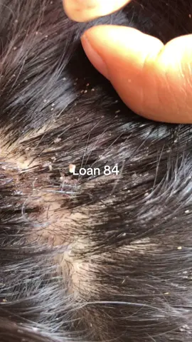 Oh, eggs and lice run so fast, I will catch them all. #omg😱😱 #lice #😱😱😱 #trending 