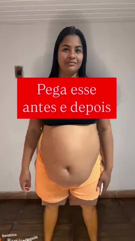 -36 kg Antes e depois emagrecimento . . . . #indonesia #creatorsearchinsights #bypassgastrico #tik_tok #saude #inspiration #antesedepoisbariatrica #antesedepois #anestesia 