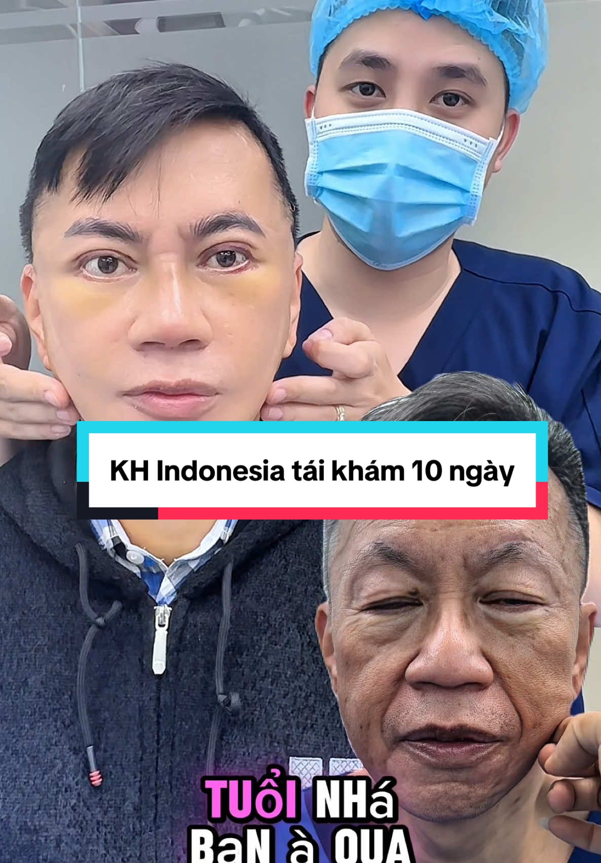 KH Indonesia tái khám sau 10 ngày #drduyha #pttm #cangdamat #facelift #necklif #catmi #eyelidsurgery #nangmui #rhinoplasty #xuhuongtiktok2025 #viral #fyp 