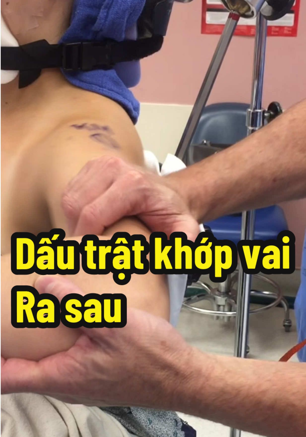 Ai bị trật khớp vai xem mình có dấu này hay không nha #tratkhopvairatruoc #tratkhopvai #longkhopvai #daukhopvai #viemganchopxoay #viemganvai #rachganvai #rachgantrengai #phauthuatchanthuongchinhhinh #bstanchinhhinh #nguyenviettan #bscoxuongkhopgioi #bscoxuonhkhop #noisoikhopvai 