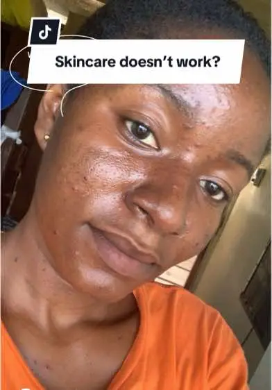 Time, patience and a lot of cash but clear skin goals is achievable  #skinjourney #fypviralシ #relatable #creatorsearchinsights 