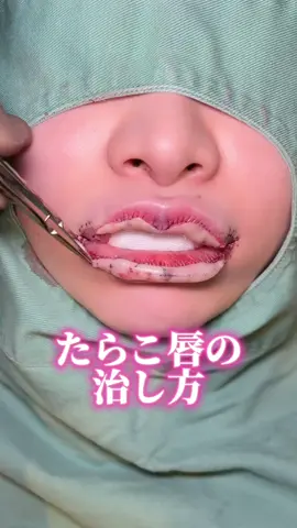 たらこ唇って治せるの？！ #唇 #唇整形 #lip #整形 #たらこ唇 #fatlips #plumplips #banana 