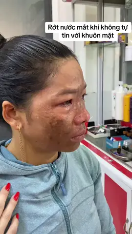 Đừng để nám làm ảnh hưởng đến cuộc sống của bạn...kem nám nhật bản là sản phẩm giúp bạn xoá mọi âu lo về nám 