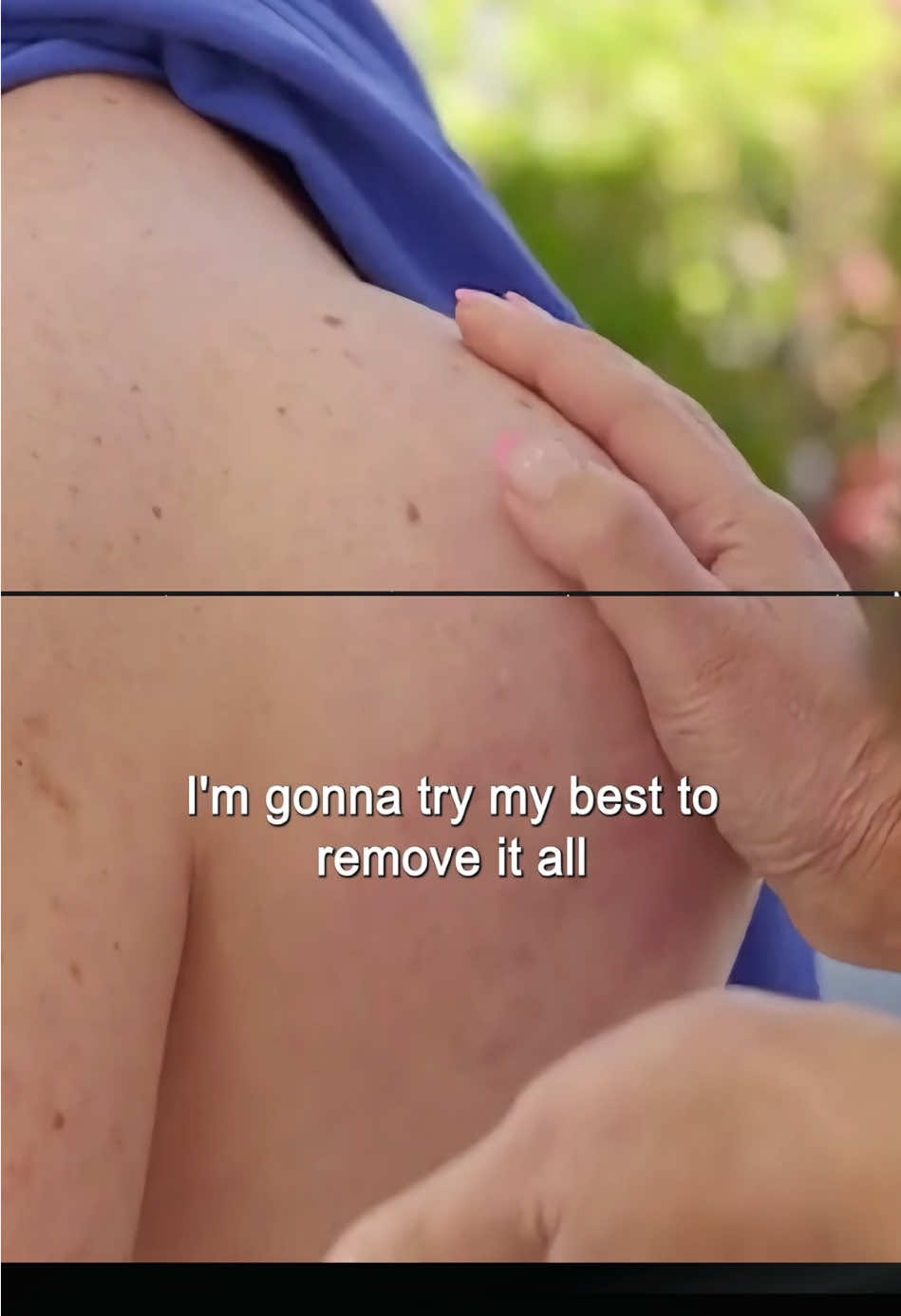 Part 3#pimplepopping #drpimplepopper #skincareroutine 