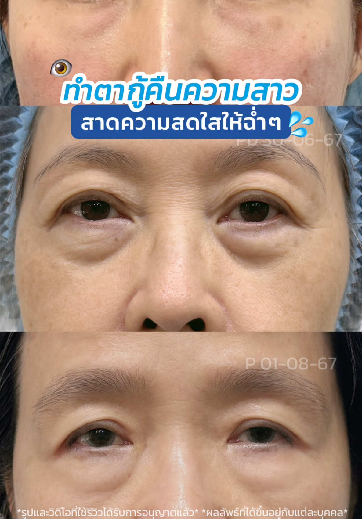 ทำตากู้คืนความสาว สาดความสดใสให้ฉ่ำ 💦😍 #skyclinic #รีวิวตาสองชั้น #หมอสกาย #ทำตาที่ไหนดี #สกายคลินิก #จักษุแพทย์ #ถุงใต้ตา #ตัดถุงใต้ตา #ศัลยกรรมตา #ผู้สูงอายุ 