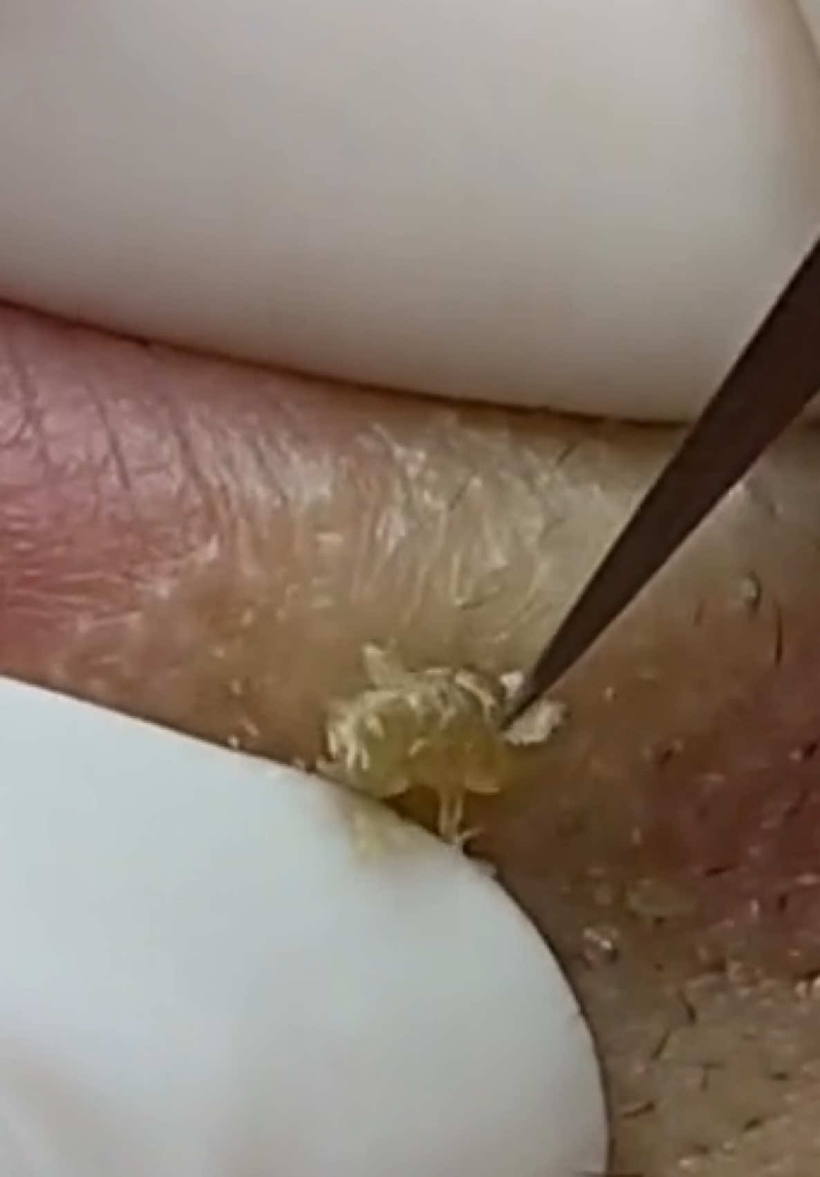 for more videos : notbored.blog/popping Blackhead removal / Pimple popping / Pimple Patch  #pimpleremover #pimple #pimplepopping #popping #blackheadremoval #blackhead #acne #cyst #cystremoval #zit #skincare #pimplepopper #drpimplepopper #zits #pimplepatch #pimplepatcher