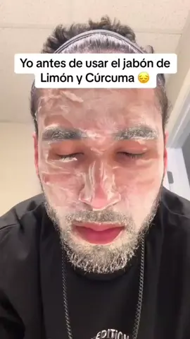 jabón de cúrcuma con ácido cójico elimina manchas y acné. #manchasenlapiel #skincare #acnefighter #melasma 