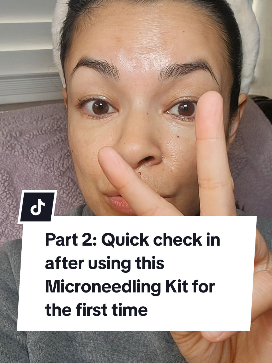 Part 2: Quick check in after using the Seranova Microneedling Infusion Kit #microneedling #microneedlingface #microneedlingbeforeandafter #skincare #skincarereview #seranova 