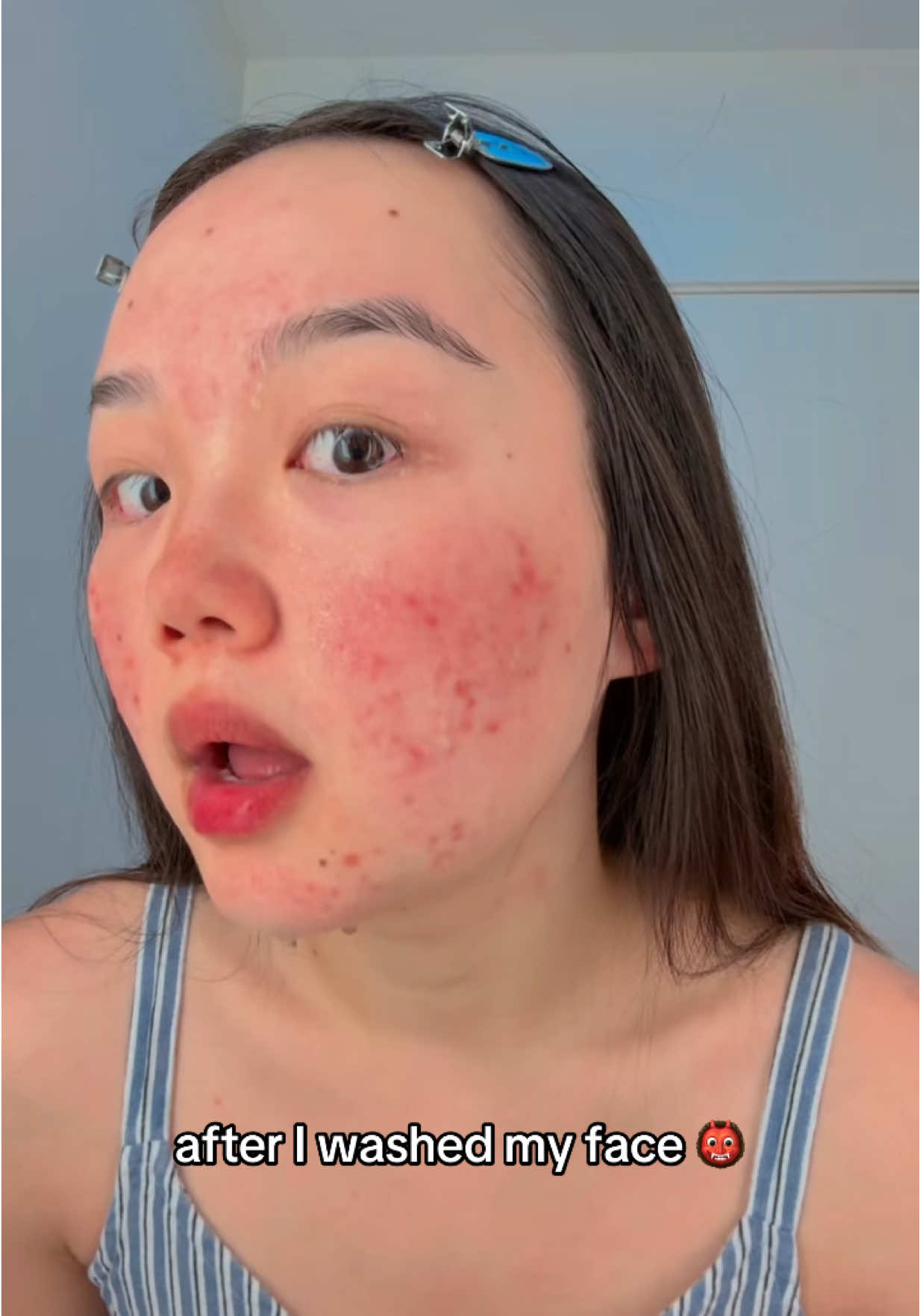Does anyone else experience fake clear skin in the morning? 🫠🥲  ##acne##skincare##relatable##clearskin