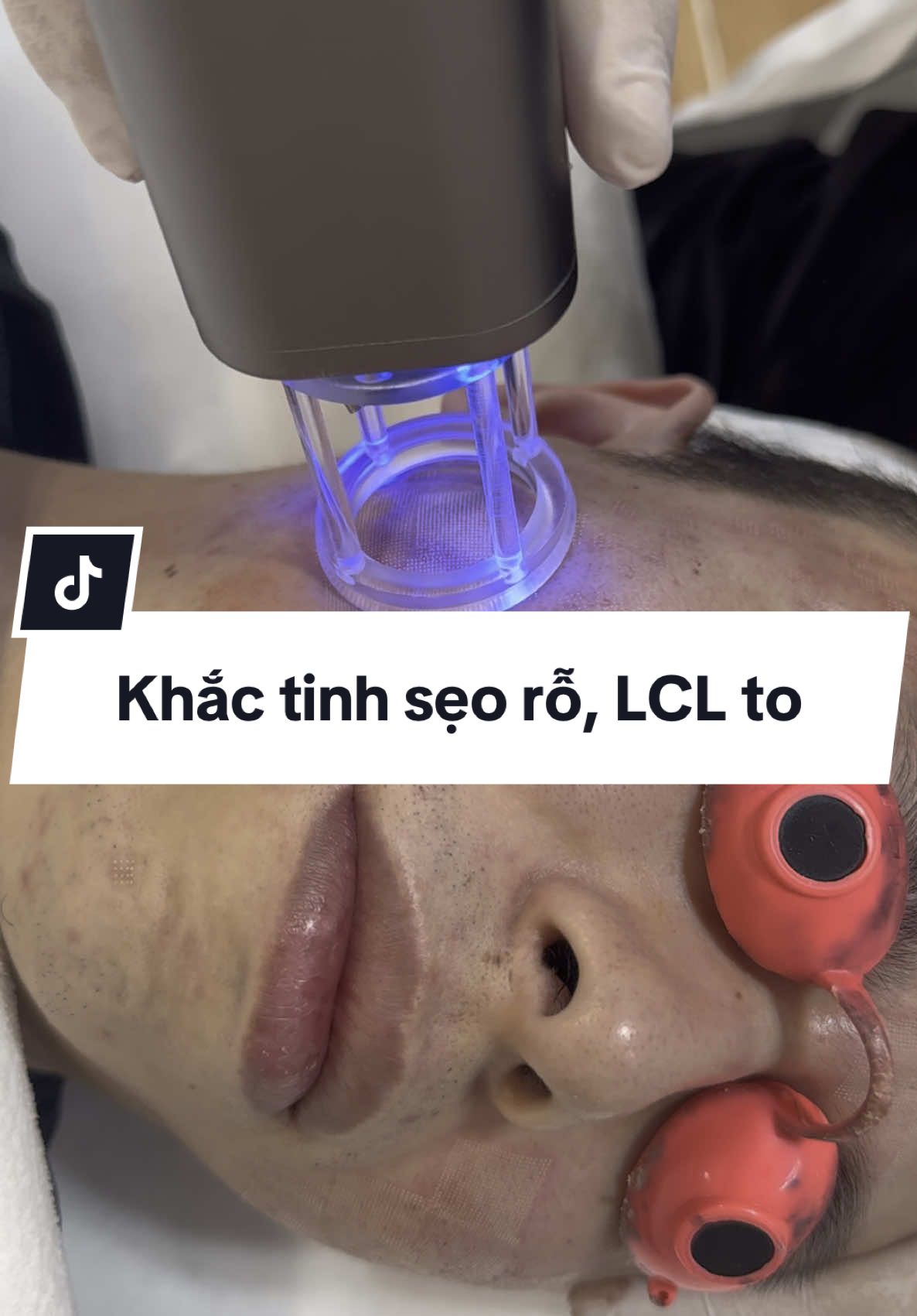 Sẹo rỗ, lỗ chân lông to có chữa được không ?#seoro #laserfractional #lochanlongto 