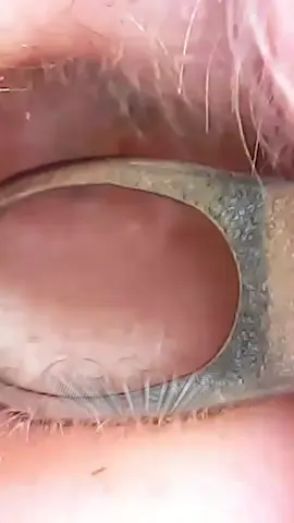 NARLY POP INSIDE THE EAR#pop #pimple #satisfying #fyp
