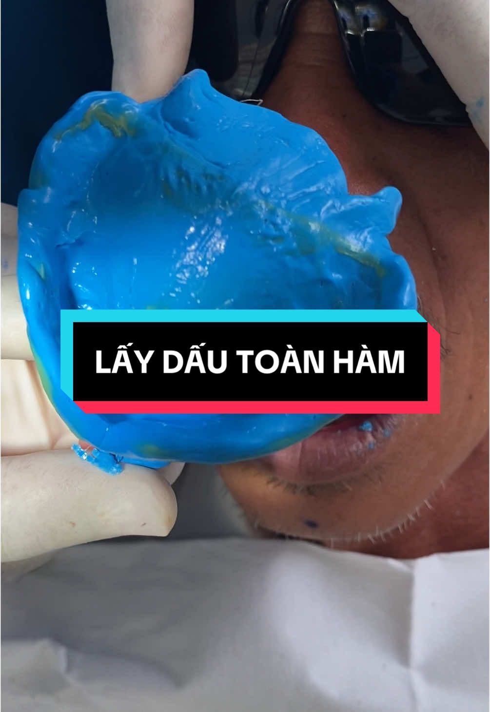 LẤY DẤU ĐỘNG - Giai đoạn quan trọng nhất quyết định độ hít dính lưu giữ của một hàm tháo lắp.  NHA KHOA VUI - 100% Bác sĩ Răng Hàm Mặt - ĐH Y Dược TPHCM Địa chỉ: 37 Ấp Bắc P4 Mỹ Tho SĐT 0828282809 #nhakhoauytin #mytho #tiengiang #xuhuong #ranggia #tiktokvn 