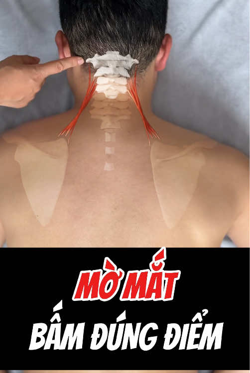 Mờ mắt bấm đúng điểm này  #vatlytrilieu #sigmacare #viencoxuongkhopsigma #coxuongkhop #xuhuongtiktok #xuhuong 