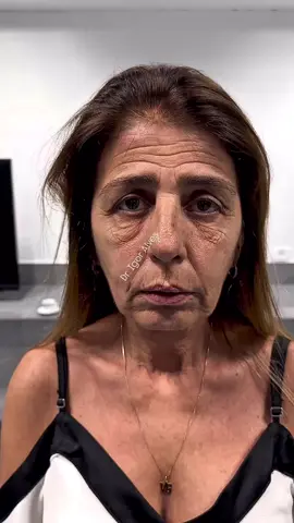 Esse é o resultado dessa paciente querida após a primeira sessão de  harmonização facial aqui na clínica Transformando Faces. A  harmonização facial tem o poder de restaurar a beleza que está escondida. O sucesso em espaço resultados full face como esse está em seguir um método. Seja preenchimento labial, rinomodelação ou botox o procedimento feito com segurança e com naturalidade despertando a melhor versão da paciente. Harmonização facial é  sobre se sentir melhor, é sobre autoconfiança e muito mais que apenas estética.  É uma transformação de dentro pra fora.  #harmonizacaofacial #harmonize #harmonizaçãofacial #harmonização #harmonizaçãoorofacial #harmonizaçãoperfeita #transformandofaces #igoralves #preechimentodelabios #preenchimentofacial #preenchimentodeolheiras #fullface #hof #cursohof