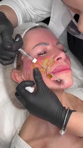 Marionette Lines: More Than Just Smile Shadows🩶💉 These deep lines pulling the corners of the mouth downward can add years to the face. ✔ Caused by fat loss, tissue descent & repetitive movement ✔ Can be softened with strategic filler placement to lift and support ✔ Always address surrounding volume loss – not just the line DM me “PROFILING” to book in for the course 🩷 #dermalfillers #facialfillers #marionettelines #facialharmonization #profilebalancing #aesthetics #fillertraining #antiaginginjectables 