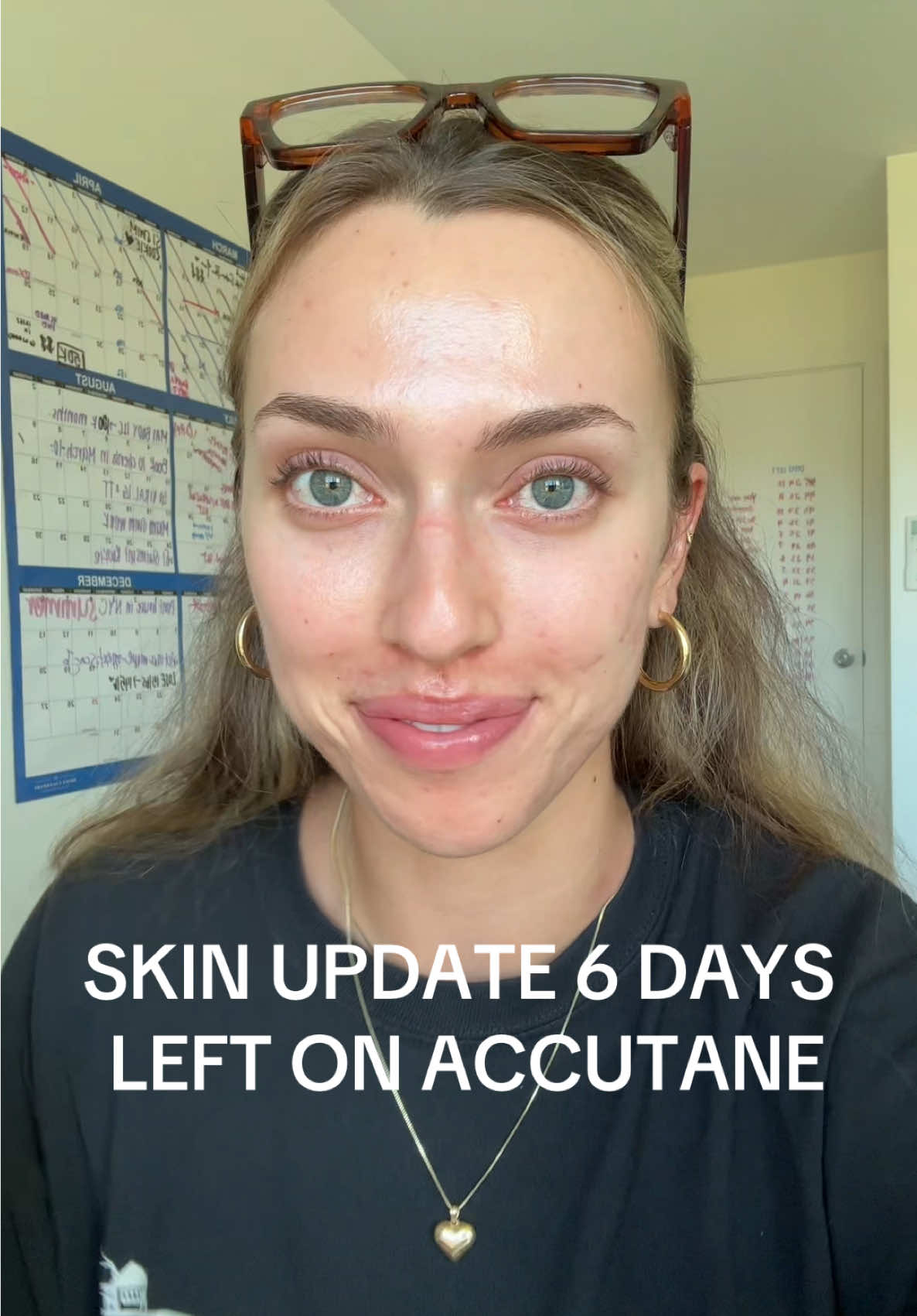 6 DAYS LEFT ON ACCUTANE 🤭🤭🤭 yall im gonna do a countdown because WHAHAAAAAA so happy. love you. #accutane #accutanejourney #accutanecheck #accutanepurge #accutanetips #acne #acneskin #acnescar #acnescars #acneproneskin #acnejourney #acnefighter #acneskincare #acnetips #acnecommunity 