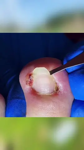 Ingrown toenail removal #ingrowntoenail #ingrownnailremoval #toenailremoval #viralvideo #podologia #pedicure #foryou #fyp