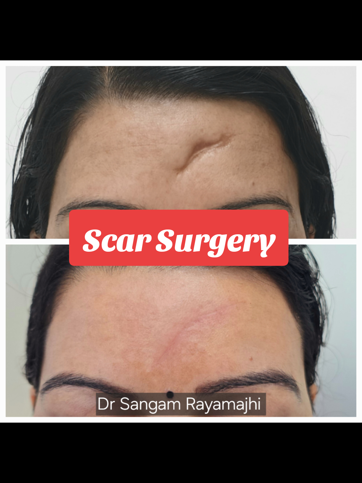 result of scar surgery take abt 6 to 12months to finalise.. its reduced to fine line.. #scarremoval #scartreatment #scarrevision #plasticsurgerynepal #skinartsnepal #drsangamrayamajhi 