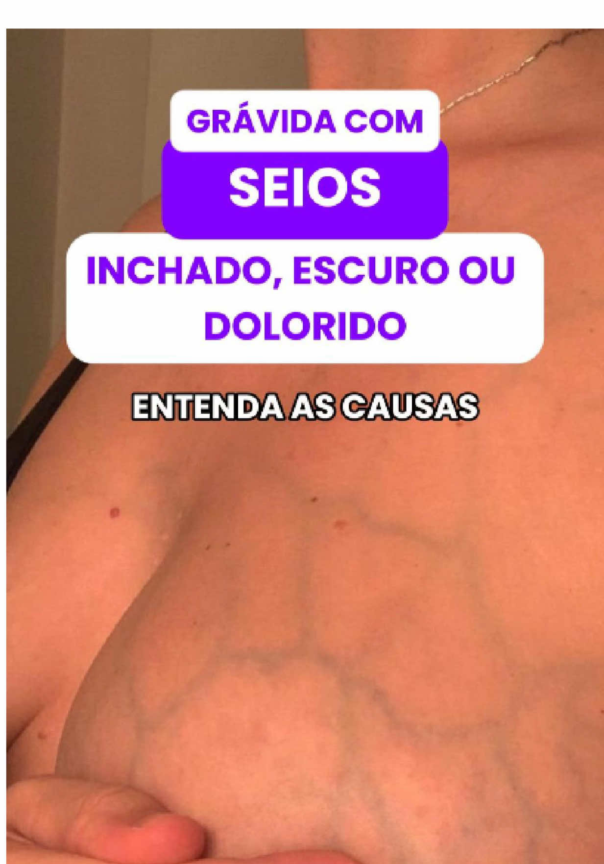 Seios inchados e doloridos na gravidez? Calma, tem explicação! A maioria dessas mudanças é totalmente normal: seu corpo está se preparando para amamentar! Marca aqui uma amiga grávida que precisa saber disso ou guarda este post para consultar depois! #gravidez #gravidaemportugal #maternidade #parto #recemnascido #mudancasnocorpo #amamentacao #enfermeiraclari 