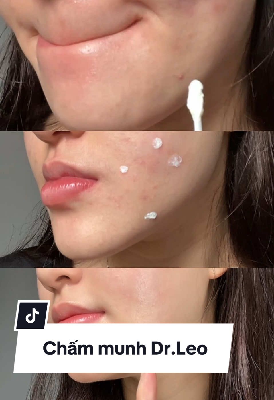 Chấm mụn nhà Dr.Leo thì khỏi phải bàn luôn ruiiii #chammundrleo #drleo #drleoVN #chamsocda #reviewlamdep #gelmun #muntrungca #chamdamun #munviem #BeautyTok #chammun #skincare #fyp