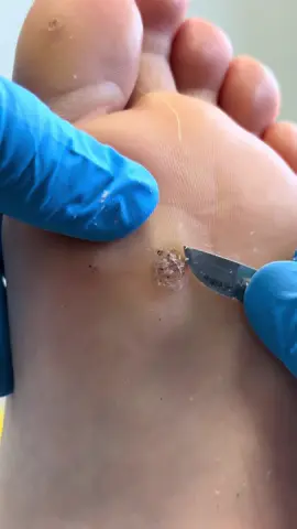 #CapCut #thepodclinics #verruca #fyp #ThePodiatryClinics #BirminghamPodiatrist #VerrucaTreatment #Harborne #FootHealth #Verruca #WartTreatment #SatisfyingVideo 