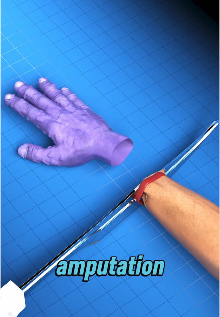 Did you know? A tight rubber band around your skin might feel fine at first, but over time, the pressure can damage nerves and blood vessels. If ignored, it could even lead to tissue death — and amputation! 🚨 Stay safe, and take care of your body! #healthawareness #bodysafety #preventinjury #nerveprotection #takecareofyourself #stayaware #tissuesafety #selfcarematters #healthtips #protectyourbody 