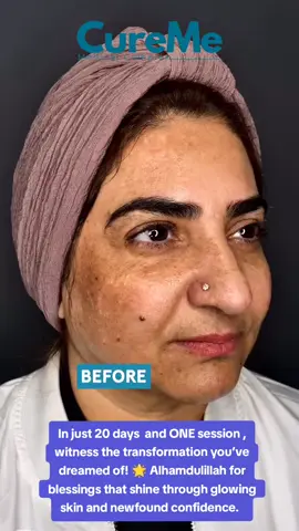 ✨ Love Your Routine, Love Your Results! ✨   In just 20 days and **ONE session, witness the transformation you’ve dreamed of! 🌟 Alhamdulillah for blessings that shine through glowing skin and newfound confidence.   P.S. Your well-being is our priority. Stay glowing, stay safe! #ExplorePage ✨ #SkincareMagic #GlowUpJourney #SkincareGoals #ExploreWithUs #LoveYourSkin   ##fyp #viral #foryou #trending #tiktokchallenge #explorepage #foryoupage #dance #comedy #LearnOnTikTok #lifehacks #Foodie #fitnessmotivation #BookTok #travel #cureme #cmc #curememedicalcomplex #curememedical