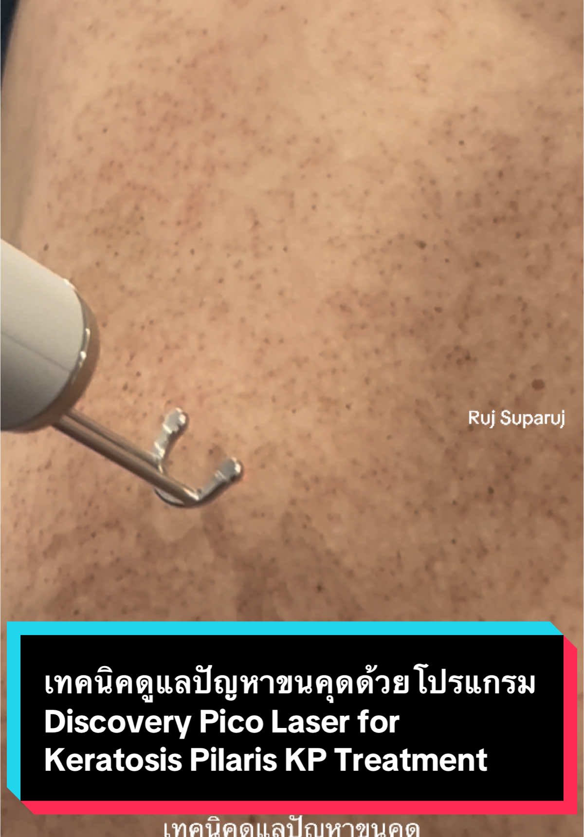 เทคนิคดูแลปัญหาขนคุดด้วยโปรแกรม Discovery Pico Laser for Keratosis Pilaris KP Treatment  ผลการรักษาขึ้นอยู่กับการตอบสนองของแต่ละบุคคล เทคนิคดูแลเสริมปัญหาขนคุดด้วยพิโคเลเซอร์ Pico Laser for Keratosis Pilaris Treatment  •ปัญหาขนคุด KP ถ้าเป็นมาก มีอาการคันแดงหรือส่งผลต่อความสวยงามความมั่นใจ หมอจะใช้เทคนิคการดูแลรักษาหลายอย่างร่วมกันเช่นการผลัดเซลล์ผิว Peeling  + เลเซอร์ และ moisturizer ครับ • การผลัดเซลล์ผิวไม่ควรมากเกินไปเพราะจะทำให้เกิดการระคายเคืองทำให้ขนคุดเห่อขึ้นได้ครับ • การใช้เลเซอร์ มีหลายชนิดที่มีการศึกษา เช่น โปรแกรม Long Pulsed NdYAG, Fractional Laser, Picosecond Laser แนะนำต้องรักษาเสริมร่วมกับวิธีอื่นด้วยครับ  •และเมื่ออาการดีขึ้นแล้วแนะนำให้ดูแลผิวด้วยการทาครีมบำรุงและหลีกเลี่ยงปัจจัยกระตุ้นอย่างต่อเนื่องครับ •หมอมีเทคนิคการดูแลผิวและการเลือกสกินแคร์สำหรับผู้ที่มีปัญหาขนคุดมาฝากกันครับ https://youtu.be/9yj1EwkoVLY * ผลการดูแลขึ้นอยู่กับการตอบสนองของแต่ละบุคคลด้วยนะครับ *  #ขนคุด#ขนคุดสีแดงb#KPrubrat#keratosispilarisrubraข#ดูแลขนคุดอ#เลเซอร์ขนคุดม#รูขุมขนอักเสบt#Keratosispilarisครีมบำรุงผิว#ครีมบํารุงผิวse#picosecondlaserข#รักษาขนคุดที่แขนอ#ขนคุดอักเสบั#วิธีรักษาขนคุดท#ขนคุดที่แขนท#ขนคุดที่หน้าท#ขนคุดที่หลังม #discov#discoverypicolaserp#RujSuparujc#demedclinicน #รุจชวนคุย  @Ruj Suparuj 