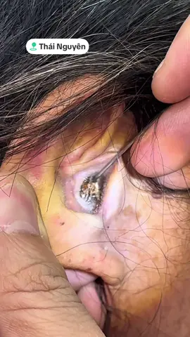 Quả ráy tai rai có từ thời kháng chiến chống Pháp nay được bác sĩ Dũng khai quật thành công!