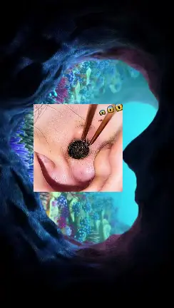 #earwax #ear #satisfying #earwaxremoval #funny #foryou #relax 