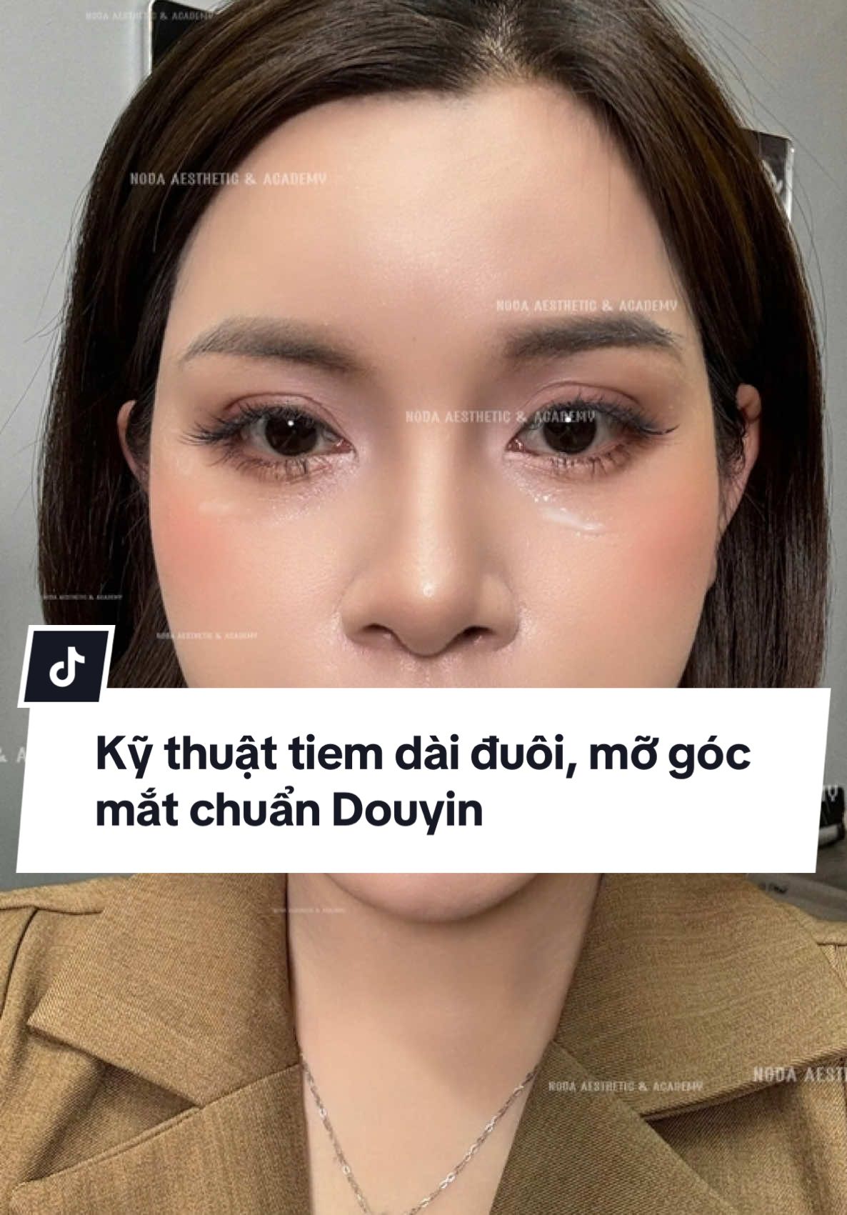 Kỹ thuật tiêm dài mắt- mở góc mắt- kích mí 1 chút , thiết kế form mắt theo từng form mắt gốc và hốc mắt của mỗi ng, cá nhân hoá mỗi case cân chỉnh . Bạn đã cập nhật kthuat sieu Hot này chưa? #vantranfiller #NovaGroup #FullFaceDouyin #China