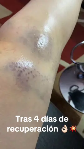 Mira el cambio en solo 4 días.  Tratamos un caso de inflamación, hematoma y dolor intenso causado por un golpe. Gracias a nuestra terapia especializada, logramos una recuperación visible y efectiva en muy poco tiempo. El cuerpo responde cuando se le trata bien. ¿Tienes dolor o una lesión reciente? ¡Escríbenos y empieza tu recuperación hoy! #Terapia #Dolor #Inflamación #AntesYDespués #RecuperaciónRápida #Salud #Rehabilitación