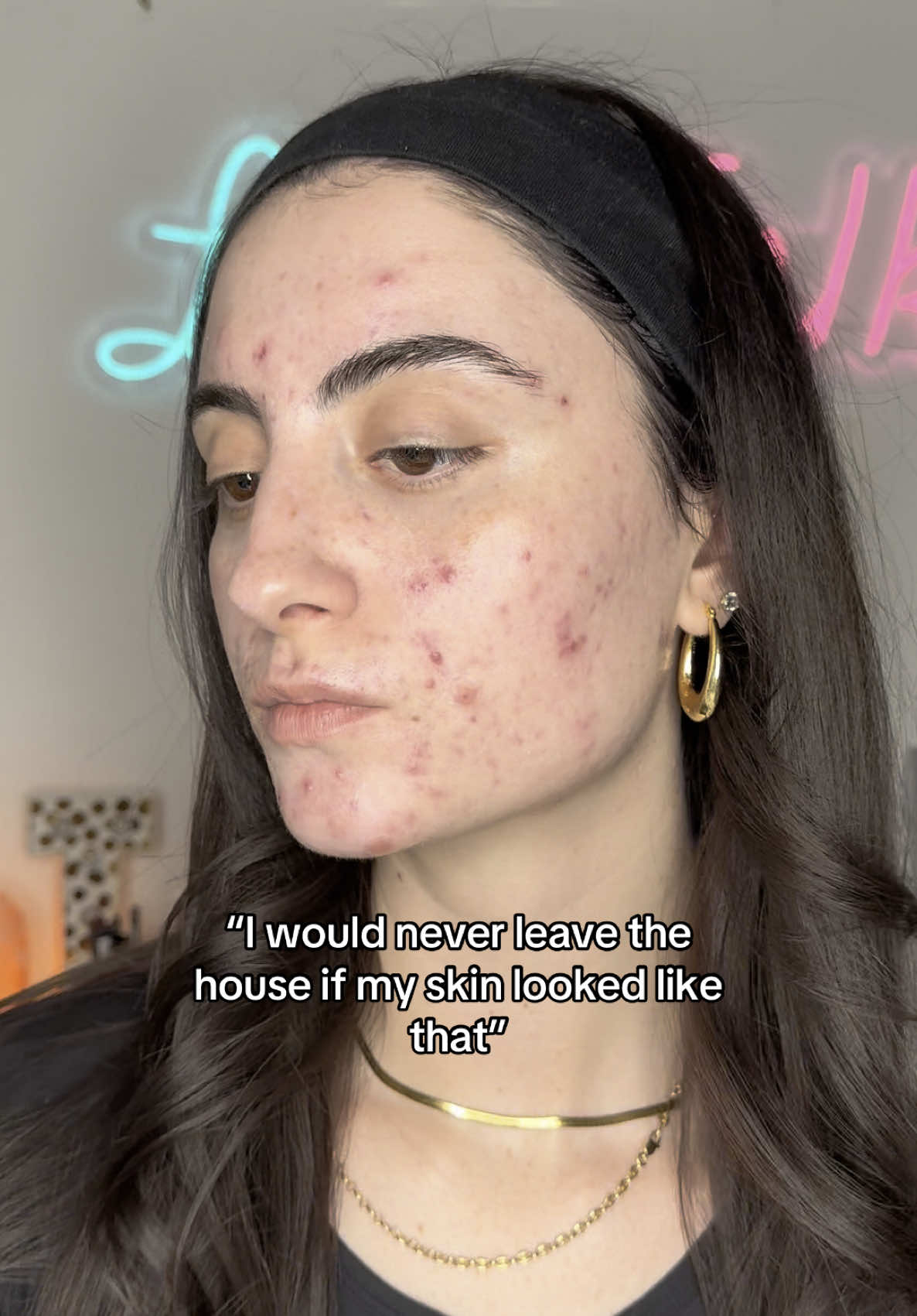Your skin only defines you if you let it 💗🥰 #realskintexture #skinpositivity #acnejourney #selflove #beautytips #makeuptutorial 