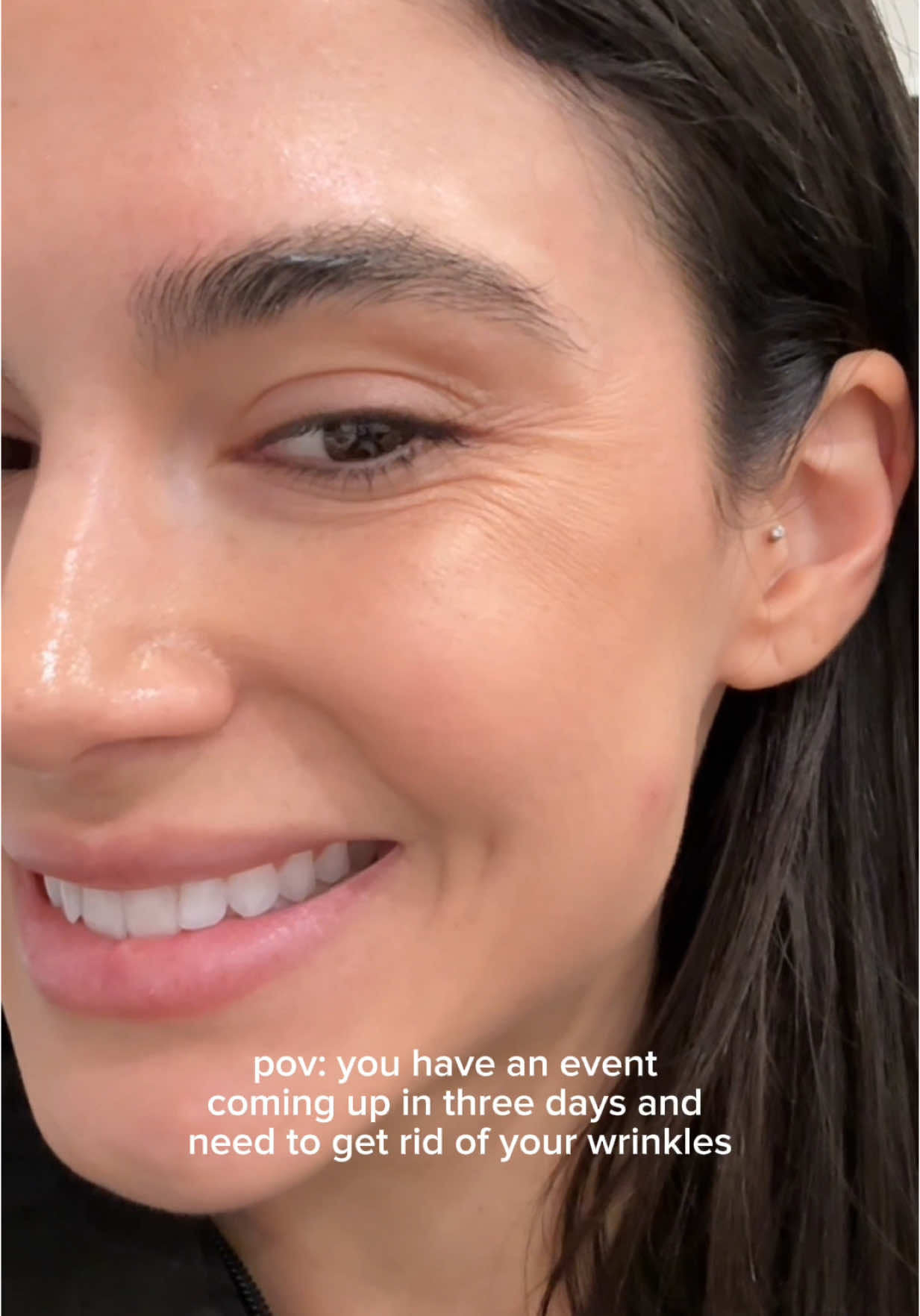 first time trying daxify and it understood the assignment 👏🏽👏🏽 #botox #antiaging #wrinkles #beforeandafter 