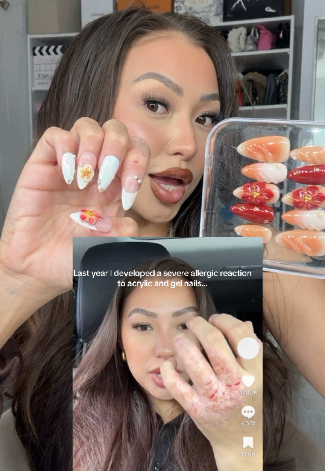 Nail salon QUALITYYYY!!! & I  hope my experience brings awareness to those who don’t know how bad an allergic / skin reactions can get to acrylic and gel nails!  Love these for my sensitive skin, it doesn’t make my eczema flare up either. I feel confident again 🥹😭🫶✨🎀  #nailsalon #pressonnails #nailset #eczema #sensitiveskin #nailsoftiktok #nailinspo #summernails 