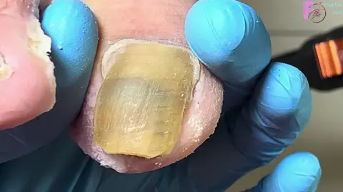 There Is A Lot Of Fungus Under The Onychomycosis Clean It Up #pedicure #naildesigns #ingrownnail #nailtutorial #nail #fungusnailstreatment #ingrowntoenail #nailart #nails #viraltiktok #nailsartvideos #fungusnails #fungus #viralvideo #viral #修脚 #trending #nailpolish #trend #toenail#laykhoemongchan❤ #laykhoe #fyp #fypシ゚viral #fyppppppppppppppppppppppp