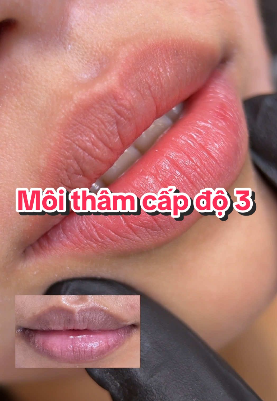 Môi thâm cấp độ 3 sau khi khử thâm sẽ như thế nào?#phunmoi #khutham #19beautystudio 