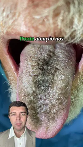Língua escurecida e peluda? O que pode ser?  Essa é uma condição rara que apesar de assustar não é contagiosa!  Veja neste vídeo como é a manifestação desta condição e o que ela representa para saúde do paciente!  Compartilhe este vídeo com amigos e familiares para ajudar este vídeo chegar a quem precisa de ajuda! #formigamento #dormencia #caimbras #dornosnervos #agulhadas #alfinetadas #pinicacao #manchasnapele #hanseniase #testerapidohanseniase #testerápidohanseníase #ultrassomdenervosperifericos #ultrassomdenervos #lepvax #medico #dermatologista #drfredbernardes Dr. Fred Bernardes Filho CREMESP 129727 Dermatologista (RQE 53117) Especialista  em hanseníase (RQE 531171)