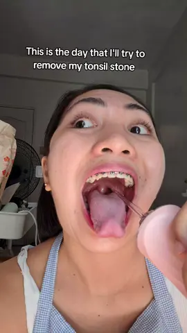 kakanood ko to ng tiktok eh. Pero legit pala talaga ang baho ng tonsil stone 😭 #tonsilstone #waterflosser #badbreath #braces #bracestips #bracescolors #oralhygiene 