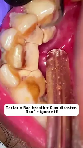 Coffee and red wine teeth, tobacco stains and yellow teeth? This ultrasonic tooth cleaner shakes away stubborn tartar in 30 seconds.🥰❤️😍#tiktoker #tiktoks #tiktokshop #foryour #girls #cutegift #gift #day #fyp #relaxing #tooth #teeth #toothbrush #tartarremoval #toothcare #cleaning #toothpaste #dentalhygienist #welldone 