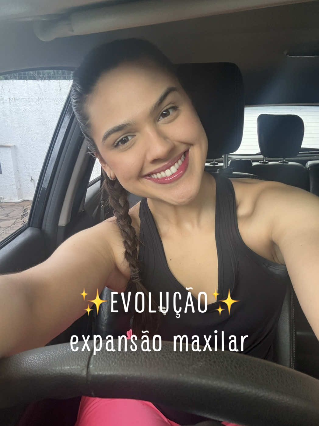 Evolução da minha expansão maxilar em 10 dias 😱 Lembrando que eu fiz expansão cirúrgica antes de começar a expansão com o aparelho Hyrax! #hyrax #diastema #expansaomaxilar #tratamentoortodontico #mordidacruzada #ortodontia #aparelhoortodontico #sarpe 